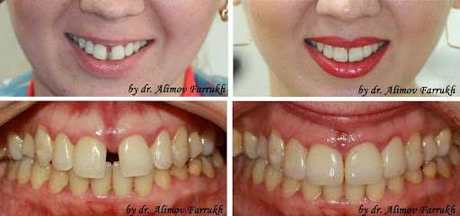 Реставрация зубов диастема