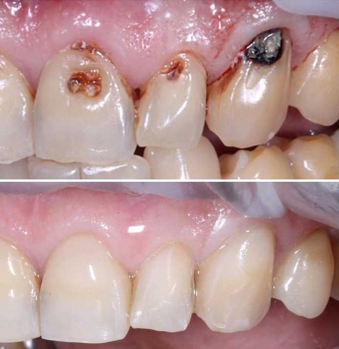 Результаты художественной реставрации зубов