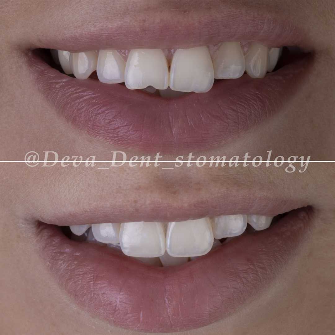 Реставрация передних и жевательных зубов