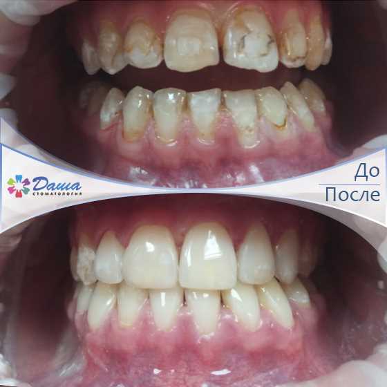 Получите безупречную улыбку — фото пре- и постаревания после реставрации зубов