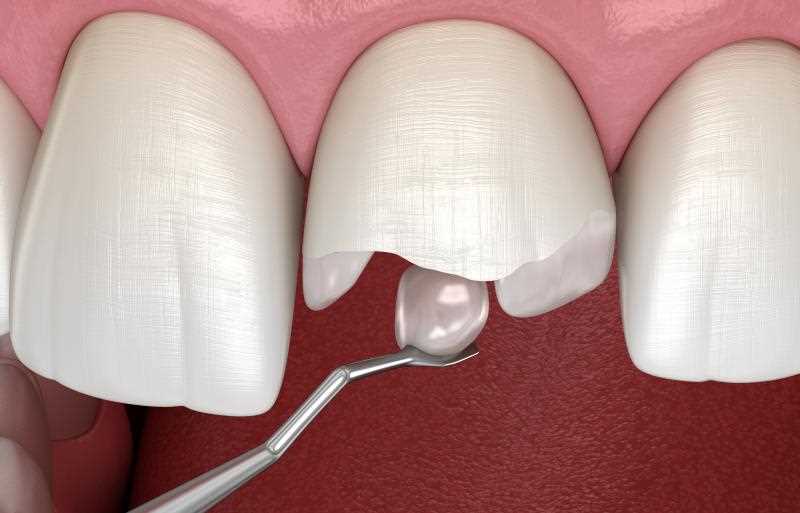 Прямое восстановление зуба композитными материалами
