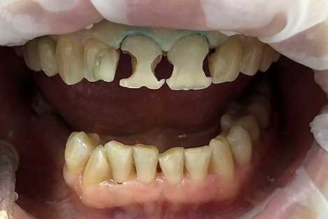 Эстетическая реставрация зубов - когда необходима?