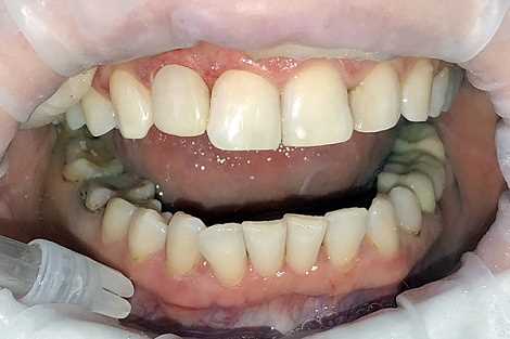 Эстетическая реставрация зубов - когда необходима