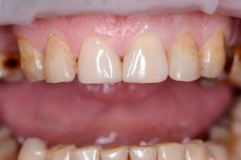 Современные методы и преимущества реставрации зубов с помощью эстетического композитного материала — эстелайт
