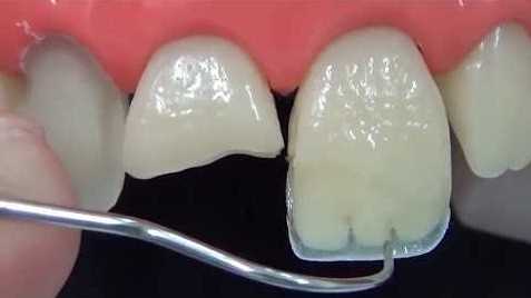Реставрация зубов фотополимерами