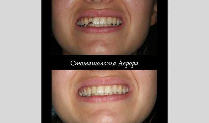 Реставрация зуба металлокерамической коронкой