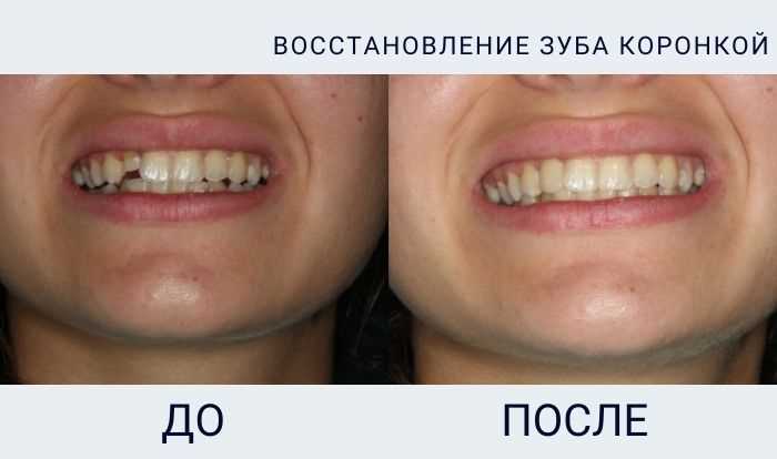 Реставрация зубов из металлокерамики