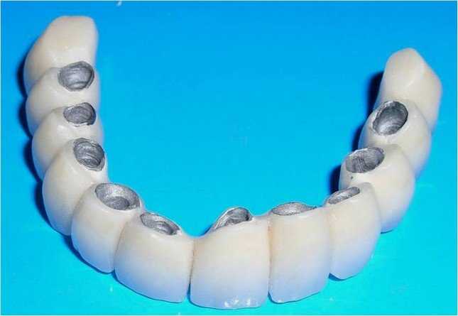 Реставрация зубов металлокерамика