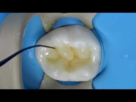 Как восстановить зубы моляров безболезненно и качественно