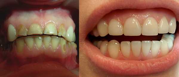 До и после установки накладок на зубы