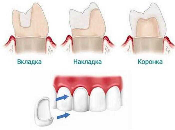Реставрация зубов накладками