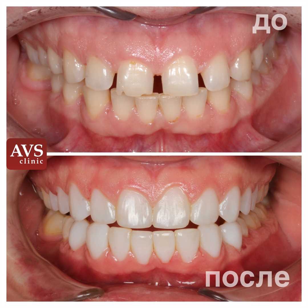 Восстановление зуба пломбировочным материалом
