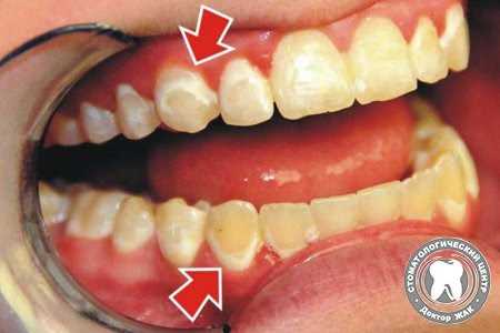 Ретенция и реставрация зубов после снятия брекетов