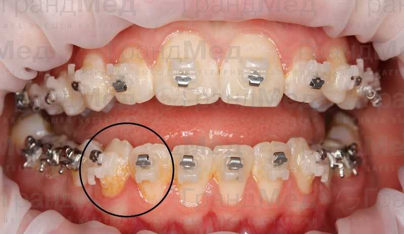4 этап – эстетическая реставрация передних верхних зубов керамическими винирами и коронкой