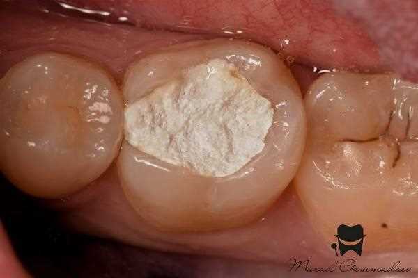 Реставрация зубов после эндодонтического лечения — основные принципы и методы восстановления здоровья и эстетики зубов