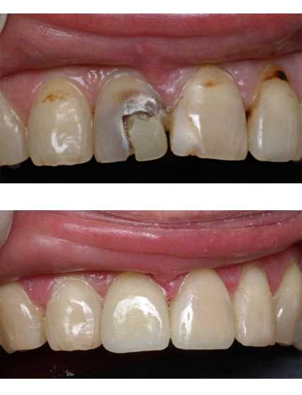 Художественная реставрация центрального зуба