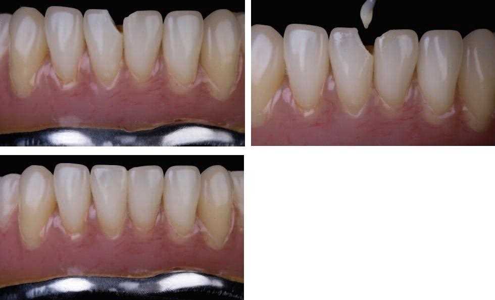 Реставрация зубов с помощью текучих композитов