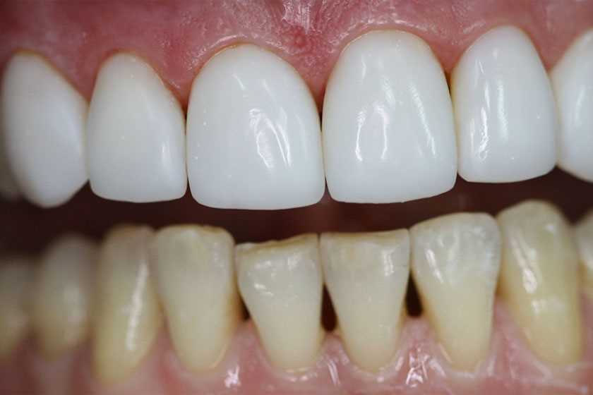 Реставрация зубов со скольки лет