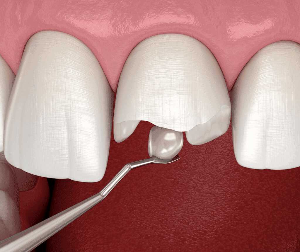 Реставрация зубов — основы, технологии, характеристики материалов и инструментария, методы обучения и самообучения