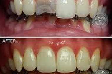 Реставрация передних зубов в «МедГарант»