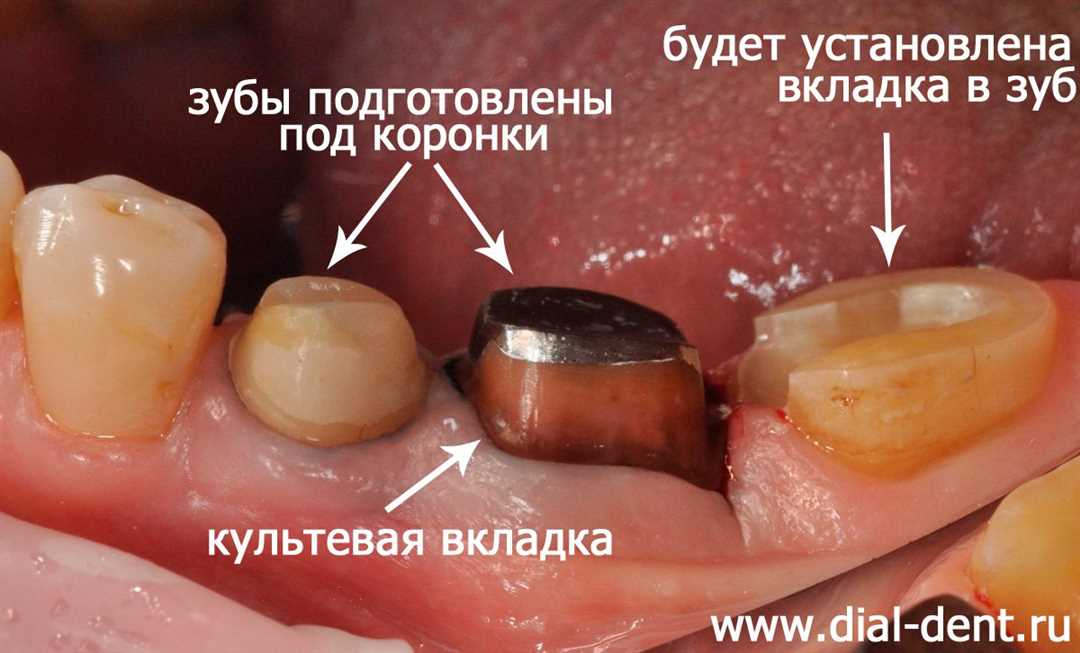 Реставрация зубов вкладками