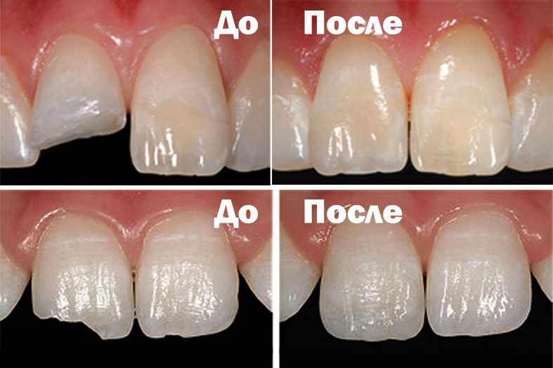 Лечение кариеса и реставрация передних зубов