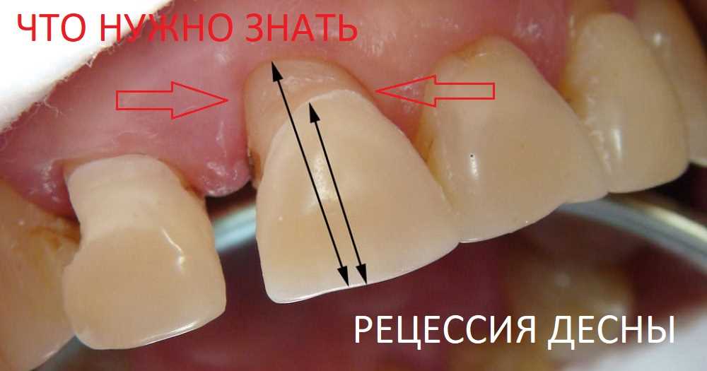 Ортодонтическое лечение и состояние десен