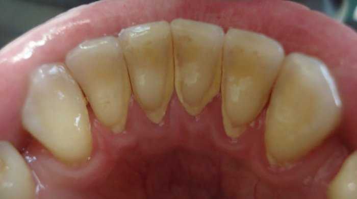 Роль зубного налета