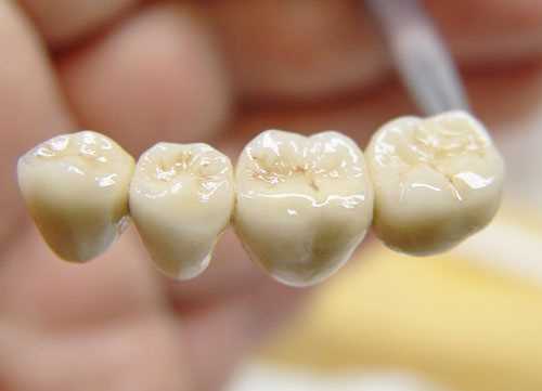 Когда необходимо восстановление зубов протезами