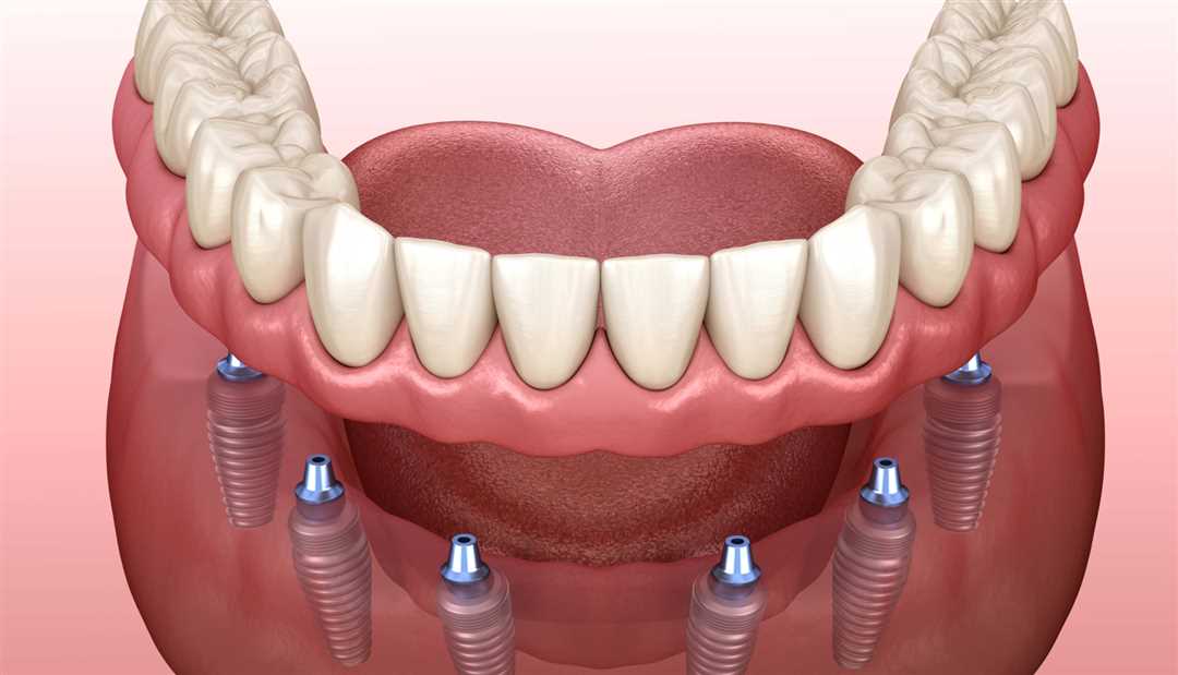 Съемное протезирование зубов на имплантах – эффективный метод восстановления улыбки и функциональности полости рта