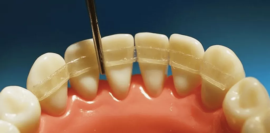 Способы реставрации зубов