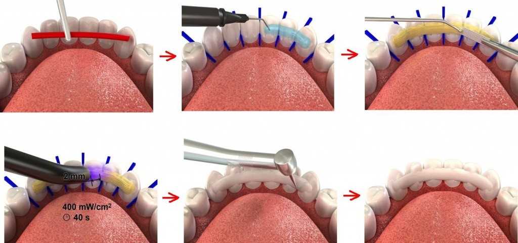 Лечение подвижности зубов шинированием
