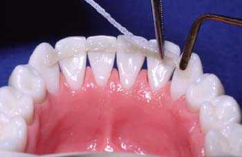 Шинирование подвижных зубов: подготовка