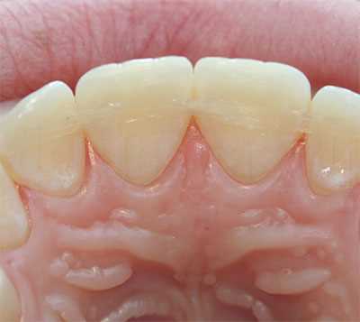 Шинирование и реставрация зубов — методы, преимущества и особенности процедур