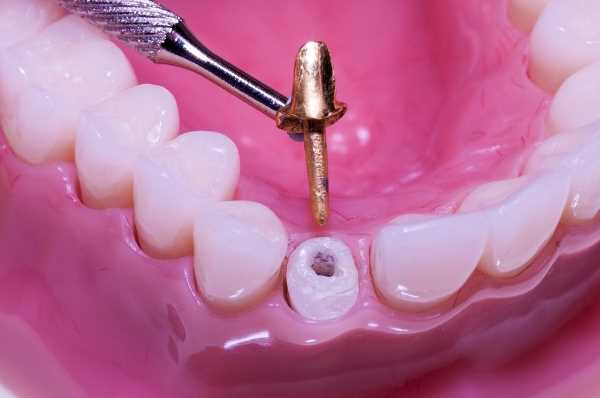 Этапы установки коронки на зуб в первое посещение
