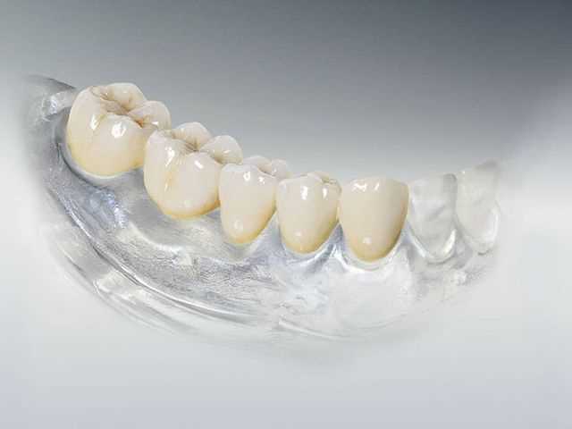 Силиконовые зубы протезирование