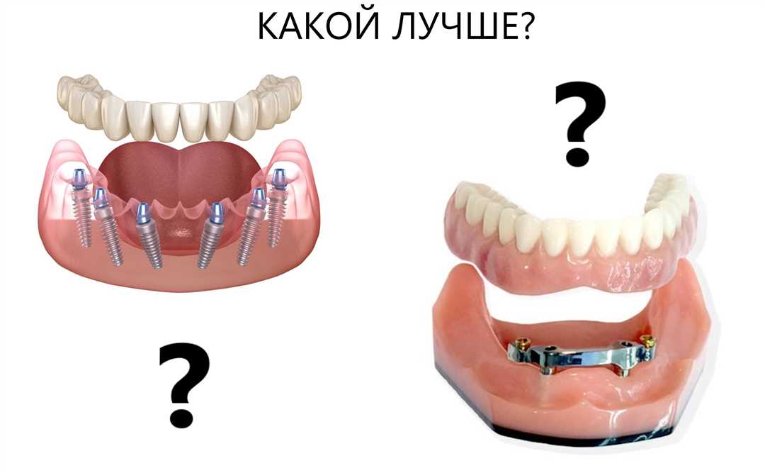 Виды систем имплантации зубов
