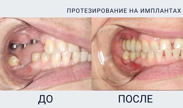 Срок службы зубной коронки