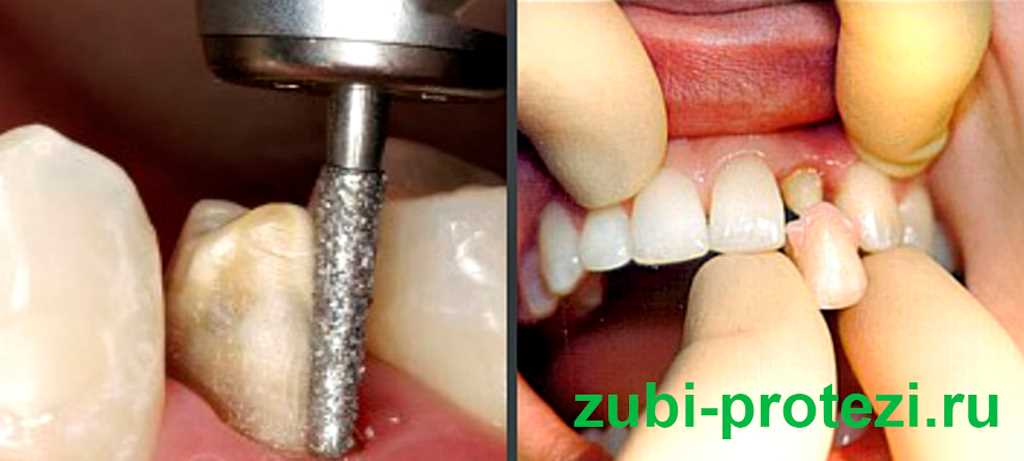 Продолжительность использования зубной коронки.
