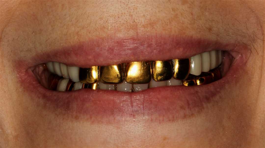 Сколько золота содержится в зубной коронке — основы, процессы и актуальные тенденции