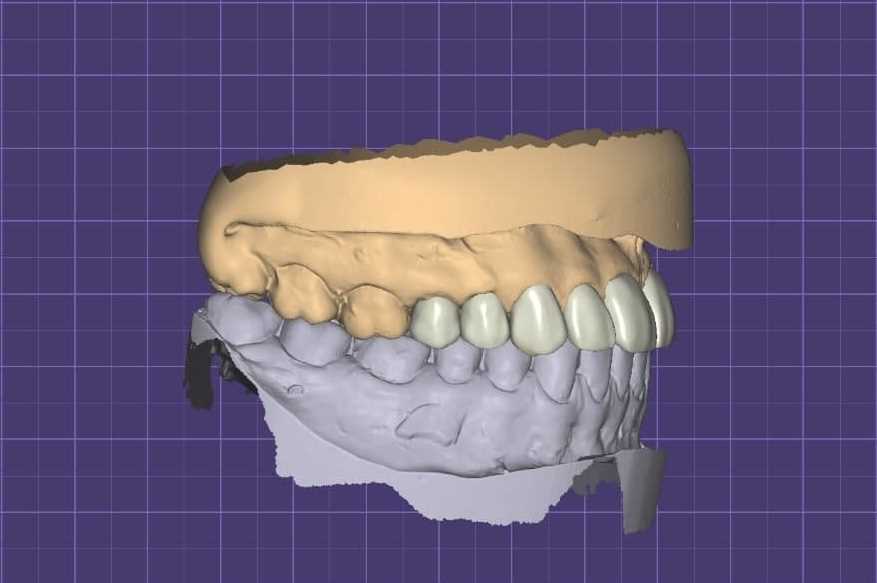 Сложное протезирование зубов