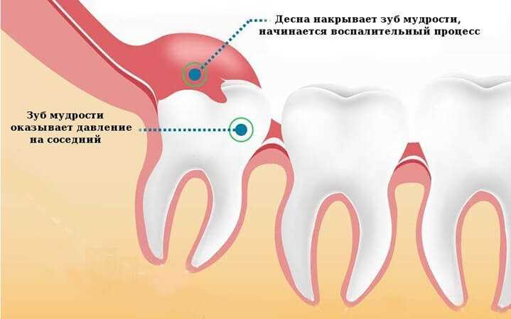 Отличие сложного удаления зуба от простого