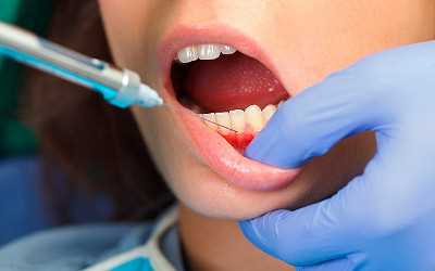Основные рекомендации после стоматологического лечения