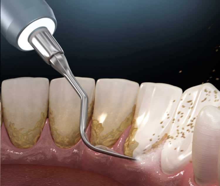 Способы удаления зубного камня