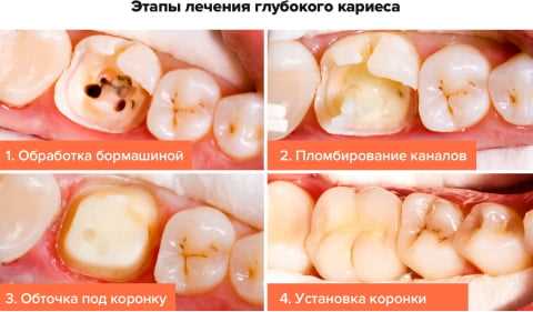Почему средства от кариеса должен назначить стоматолог