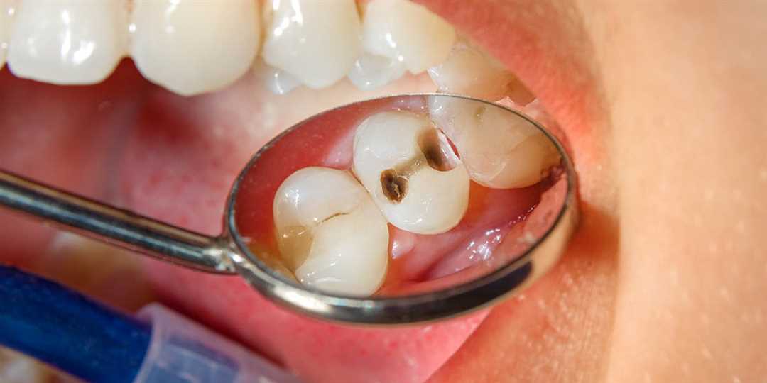 Как сделать зубы здоровыми без проблем — средство лечения кариеса, которое сработает!