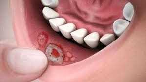 Стоматит удаления зуба