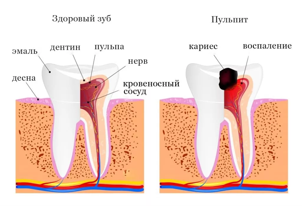 Структура осложнений после лечения кариеса пульпита периодонтита