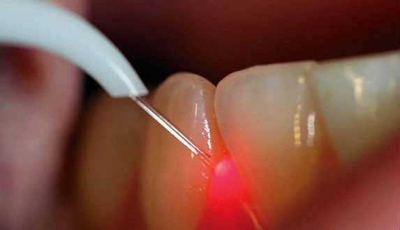 Перелечивание каналов зуба под микроскопом