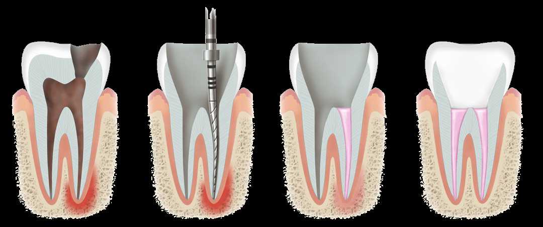 Как удаляется зубная нервная корень — все о процедуре сверления канала зуба